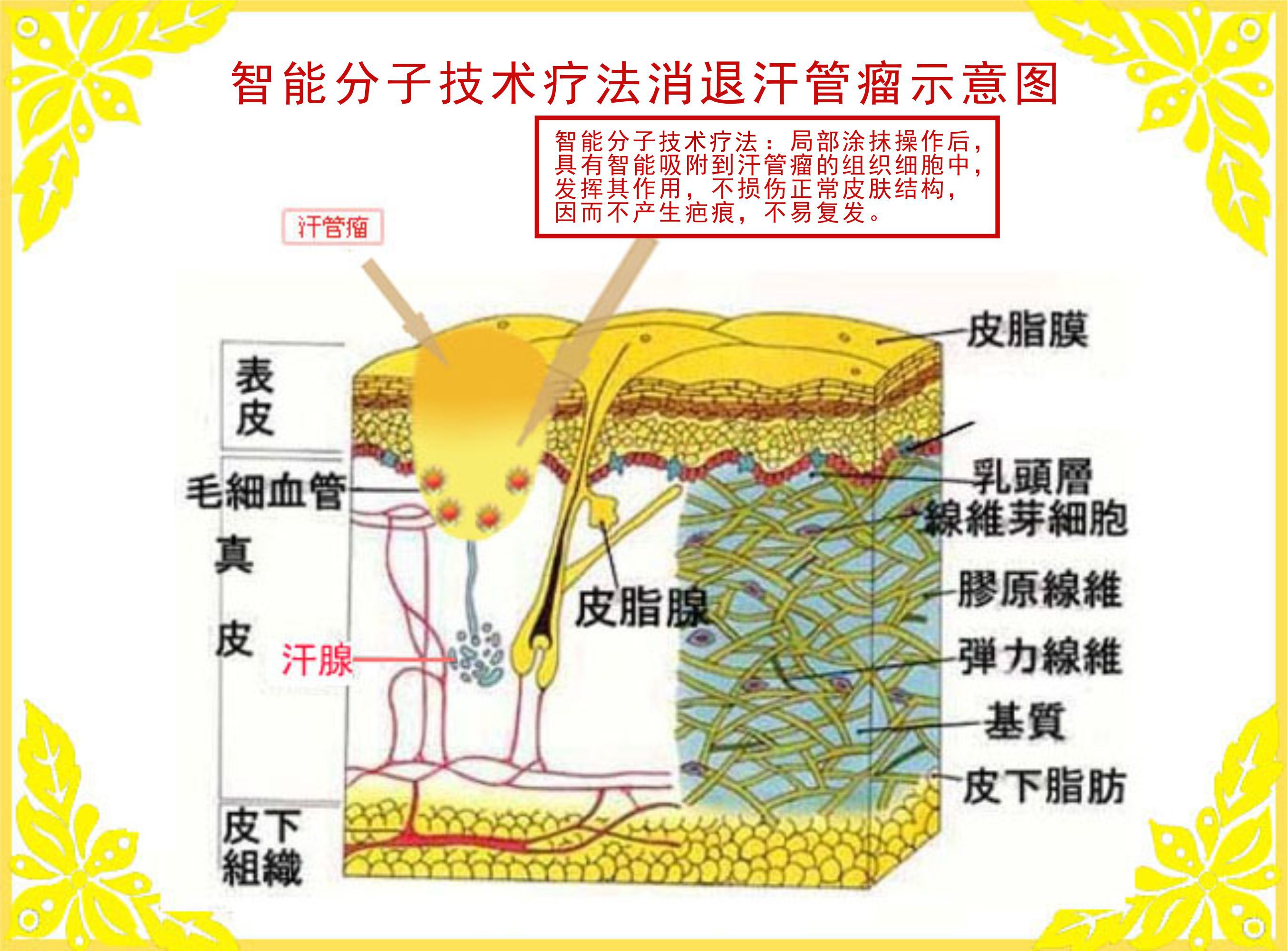 眼部汗管瘤(图1)