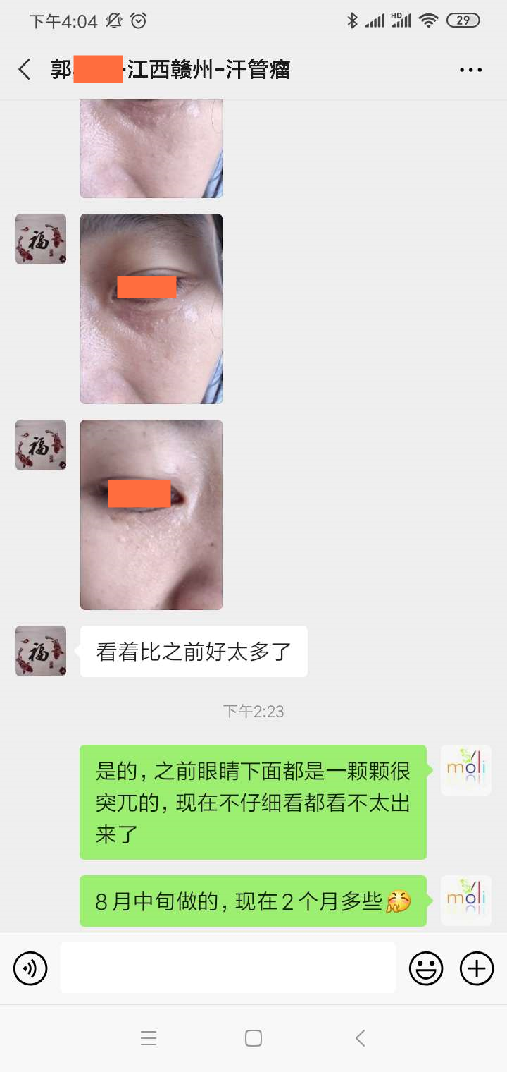 汗管瘤